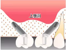 傾斜埋入