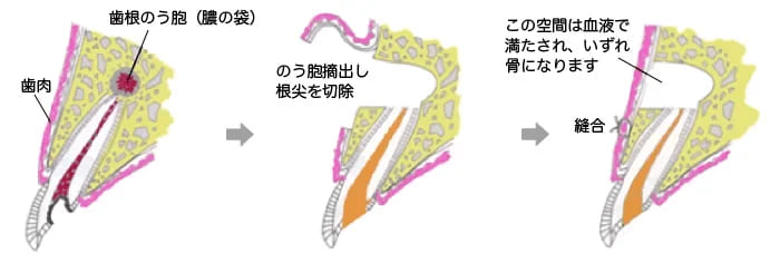 歯根端切除術